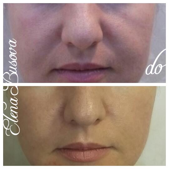 Mesosculpt c71 отзывы фото до и после Мезоскальп