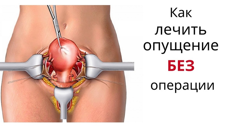 Как лечить опущение БЕЗ операции. Упражнения при опущении